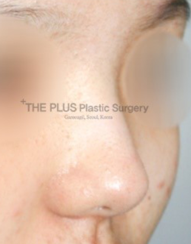 big nose rhinoplasty in korea