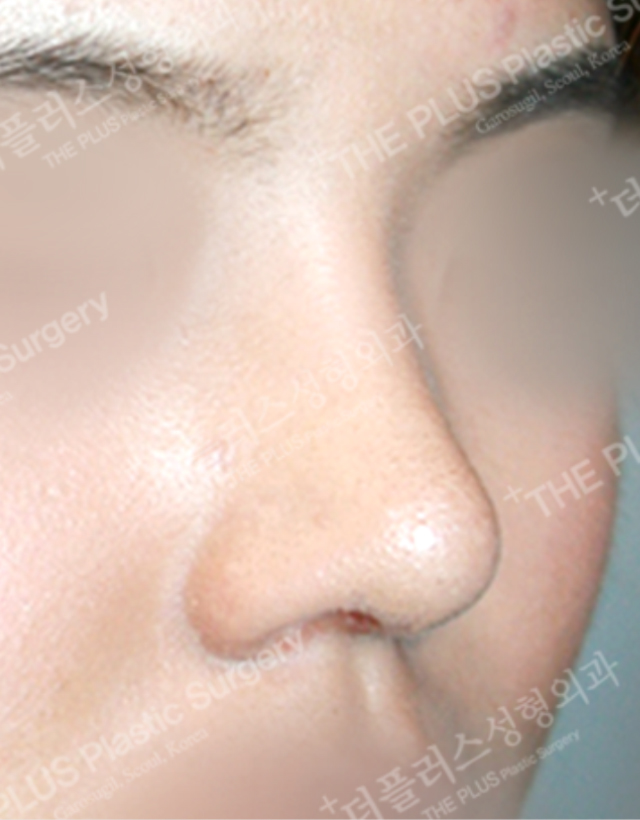 big nose rhinoplasty in korea