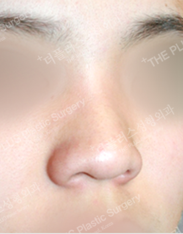 big nose rhinoplasty in korea
