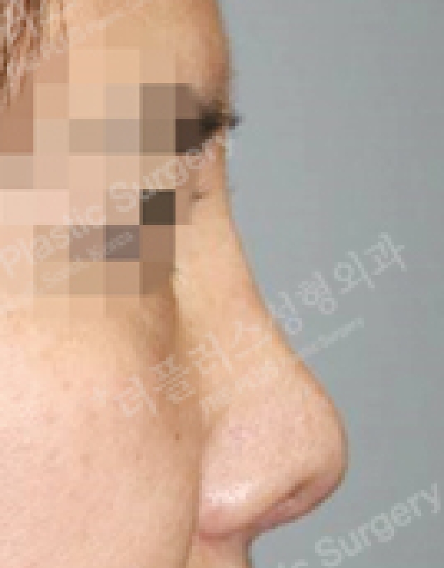contracted nose revision rhinoplasty in korea