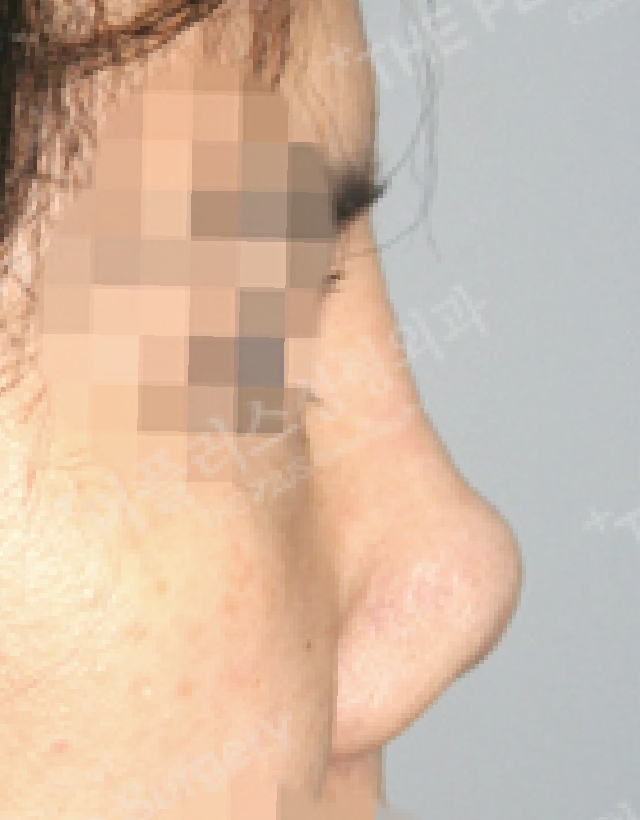 contracted nose revision rhinoplasty in korea