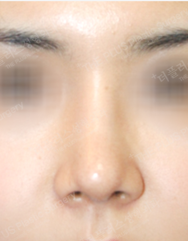 deviated nose septum in korea