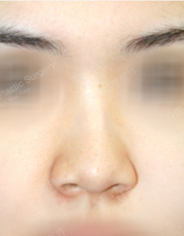 deviated nose septum in korea