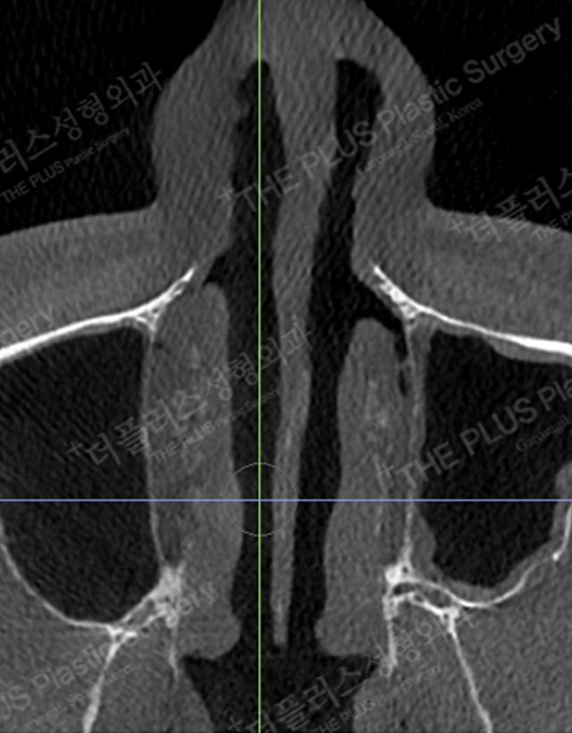 deviated nose septum in korea