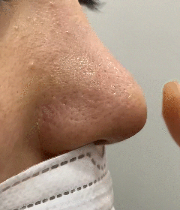 nose tip hardness revision rhinoplasty in korea