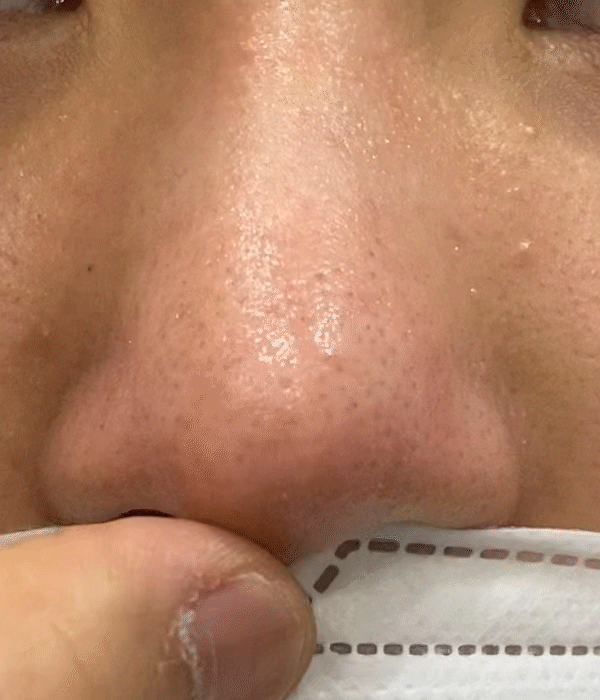 nose tip hardness revision rhinoplasty in korea