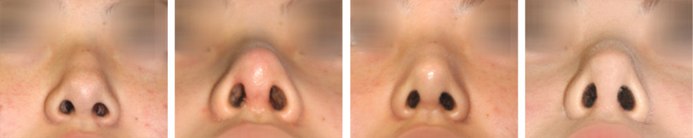 open closed rhinoplasty in korea