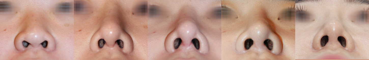 open closed rhinoplasty in korea