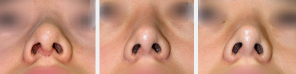 open closed rhinoplasty in korea