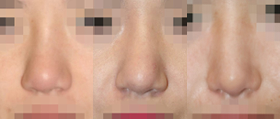 correction of failed rhinoplasty in korea