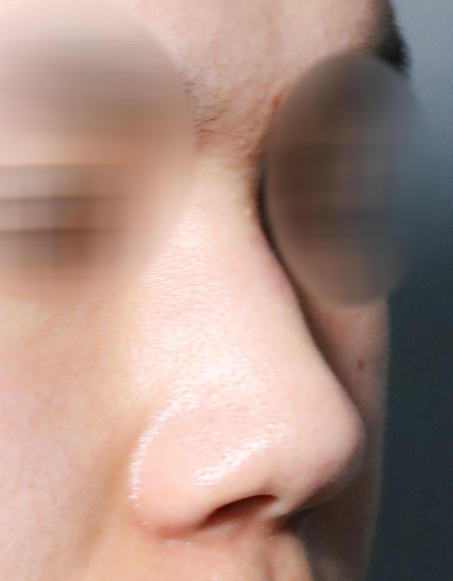 implant rhinoplasty in korea