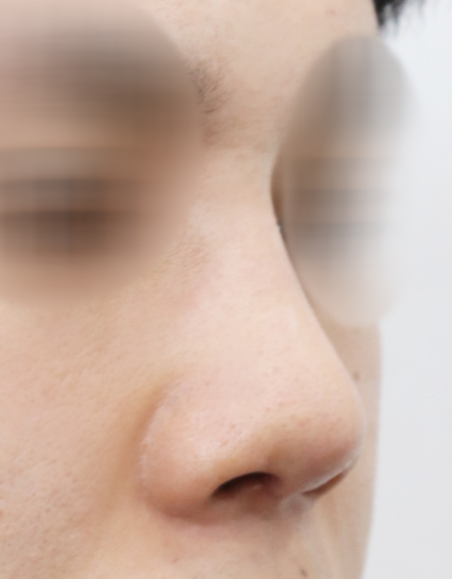 implant rhinoplasty in korea