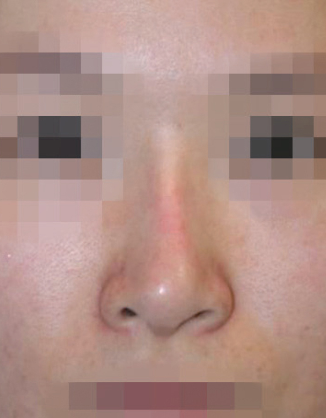 implant rhinoplasty in korea
