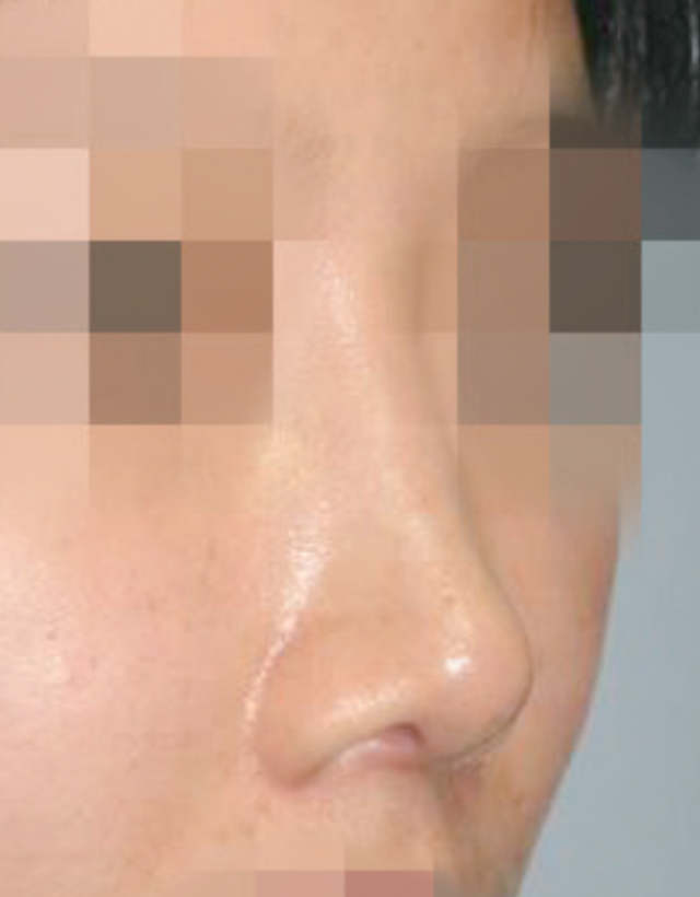 implant rhinoplasty in korea