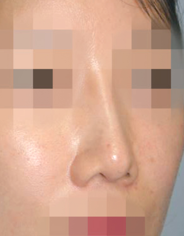 implant rhinoplasty in korea