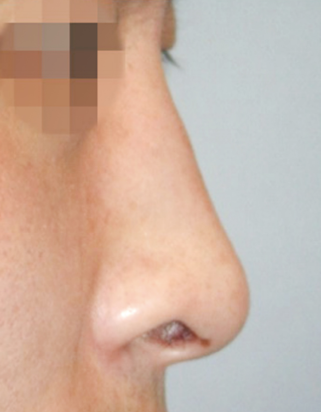 nostril nasal wing correction rhinoplasty in korea