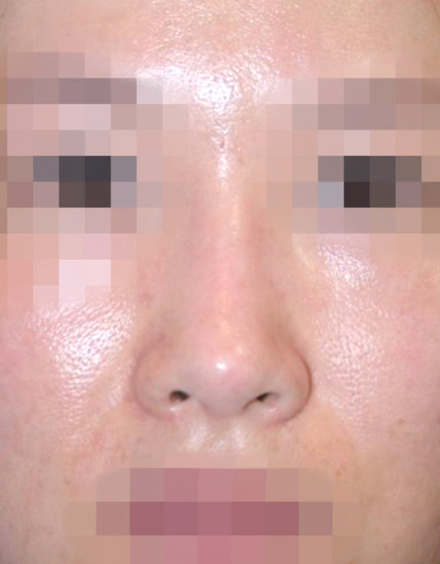 implant rhinoplasty in korea