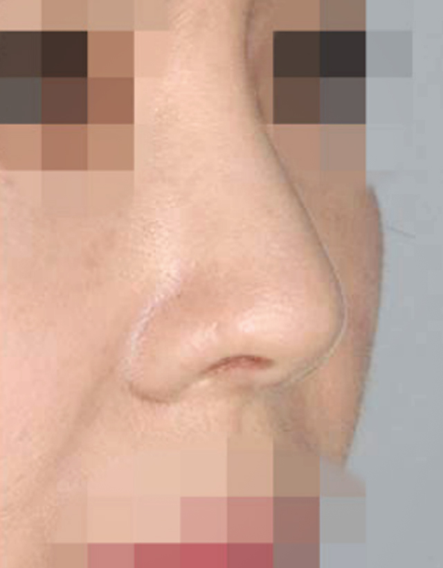 nostril nasal wing correction rhinoplasty in korea