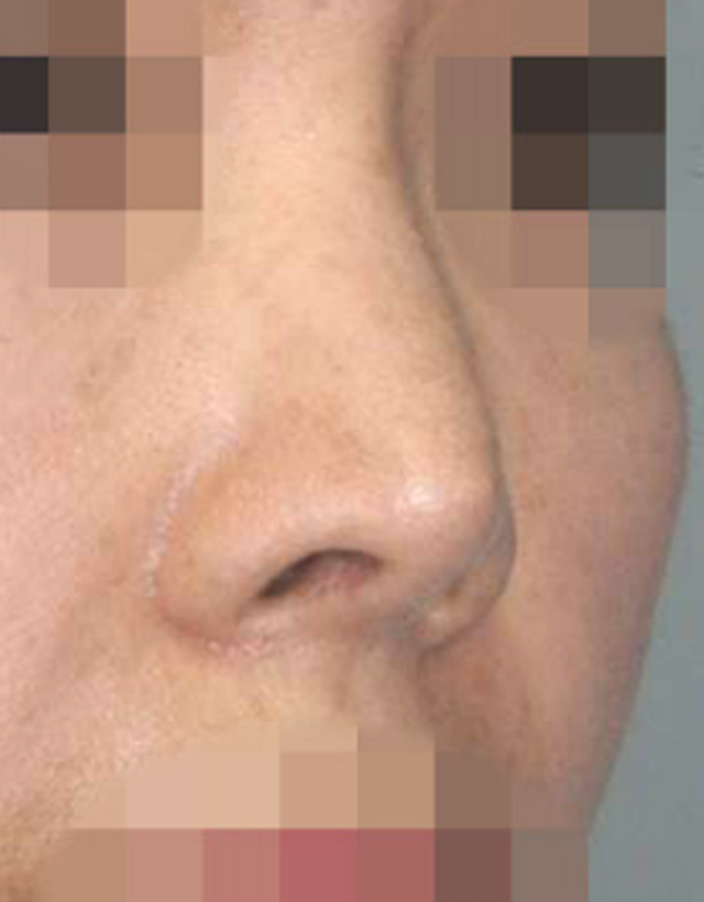nostril nasal wing correction rhinoplasty in korea