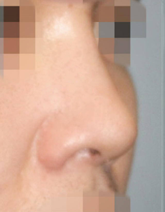 nostril nasal wing correction rhinoplasty in korea