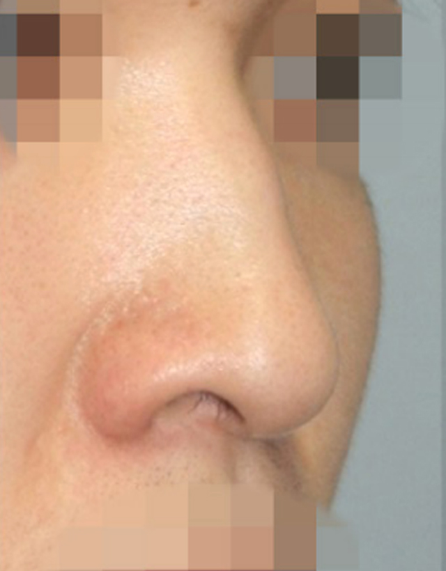 nostril nasal wing correction rhinoplasty in korea