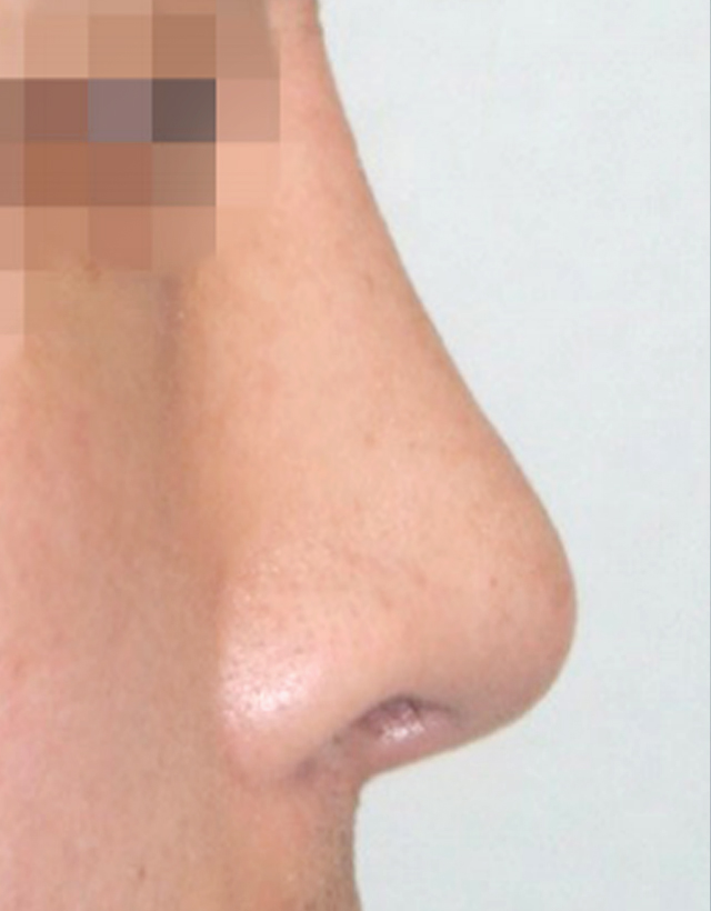 nostril nasal wing correction rhinoplasty in korea