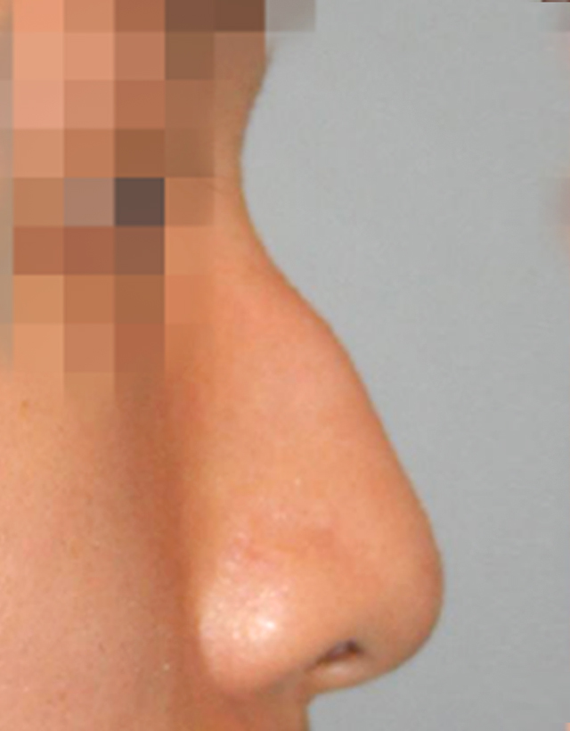 mens nose rhinoplasty in Korea