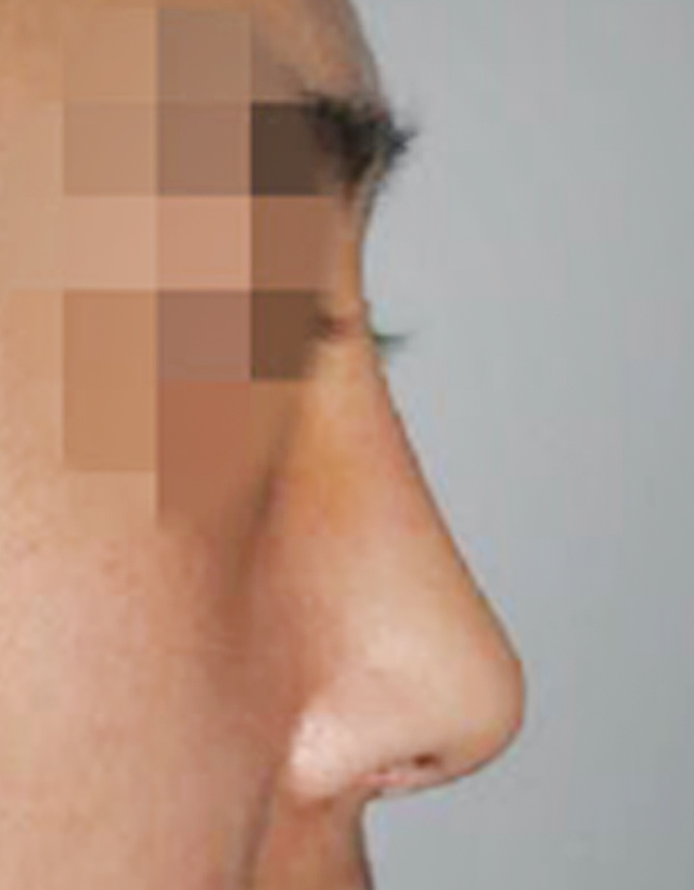 mens nose rhinoplasty in Korea