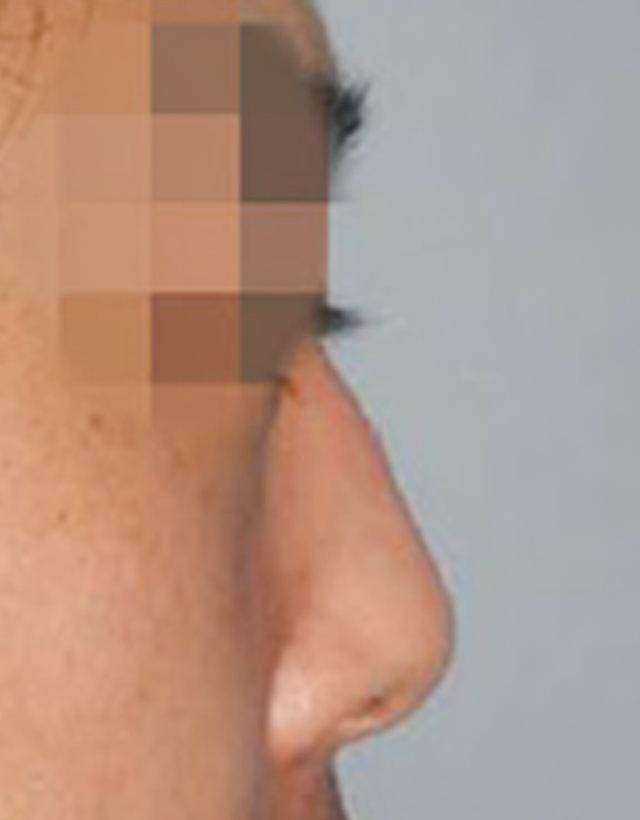 mens nose rhinoplasty in Korea