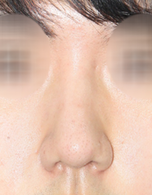 mens nose rhinoplasty in Korea