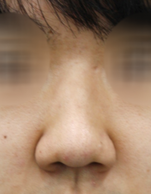 mens nose rhinoplasty in Korea