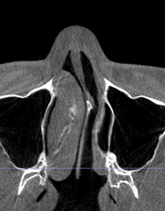 mens nose rhinoplasty in Korea