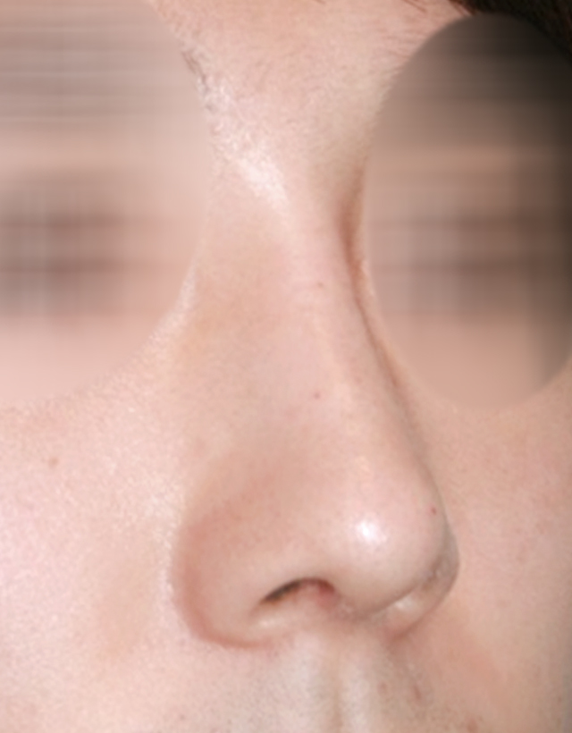 mens nose rhinoplasty in Korea