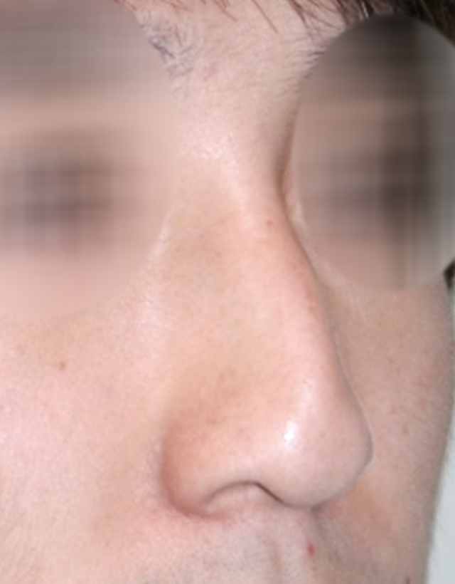 mens nose rhinoplasty in Korea