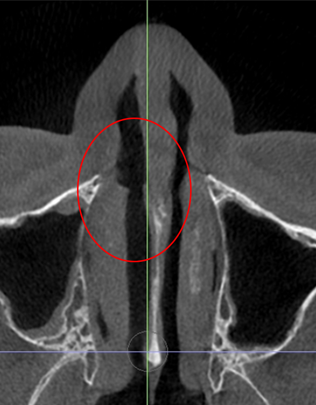 mens nose rhinoplasty in Korea