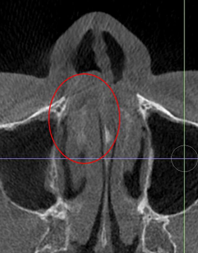mens nose rhinoplasty in Korea
