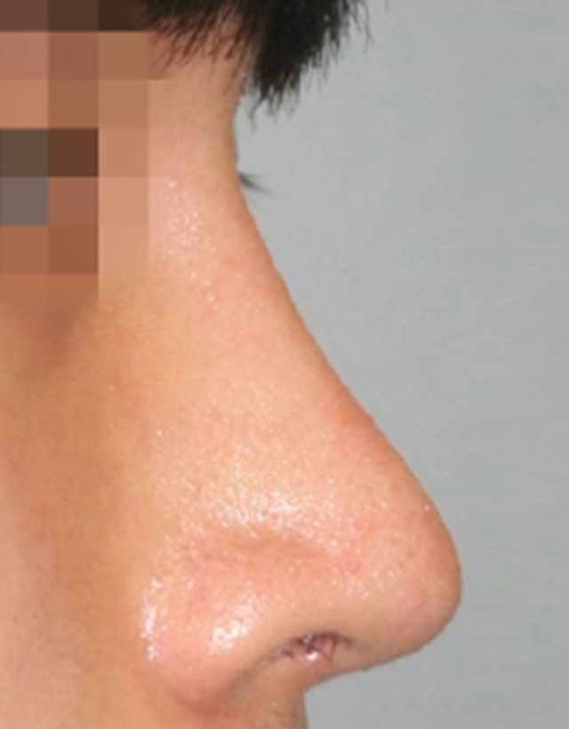 mens nose rhinoplasty in Korea