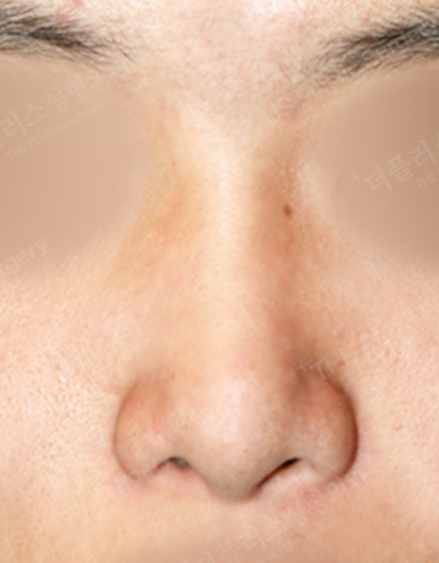 mens nose rhinoplasty in Korea