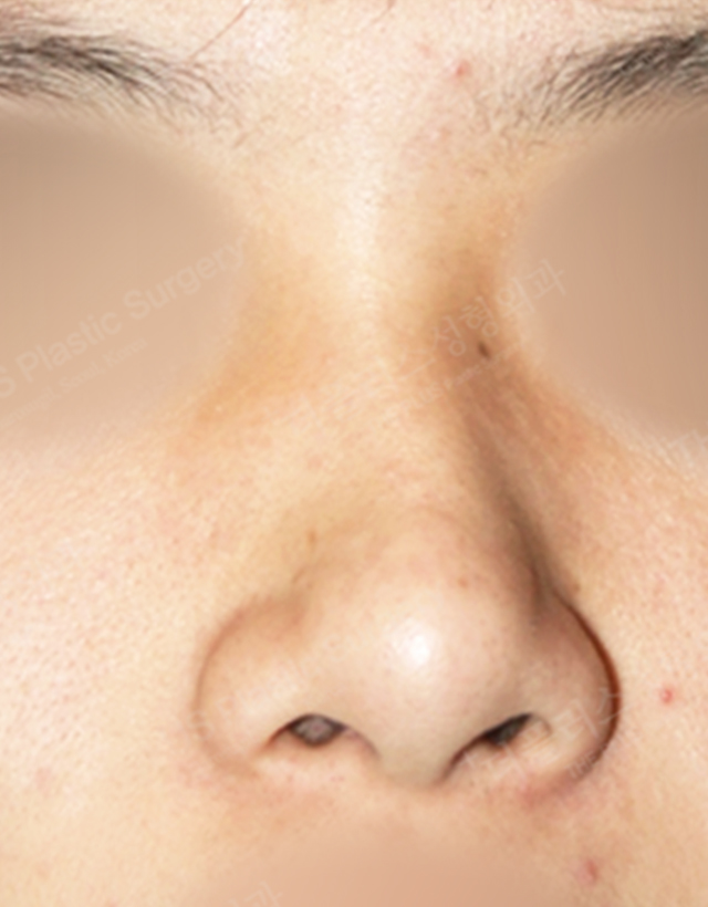 mens nose rhinoplasty korea