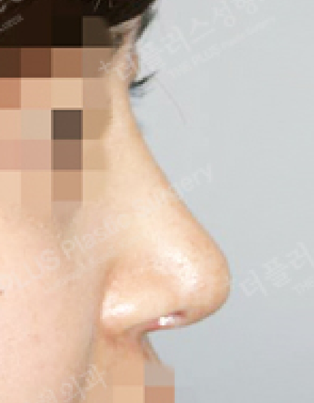 short nose rhinoplasty korea