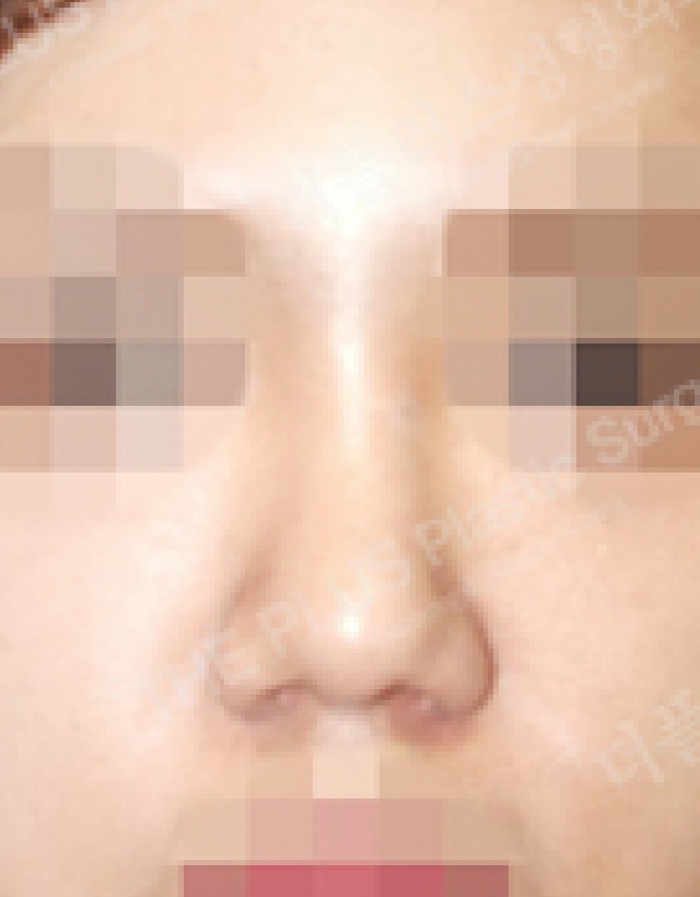 short nose rhinoplasty korea