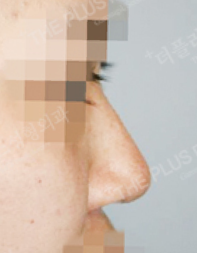 short nose rhinoplasty korea