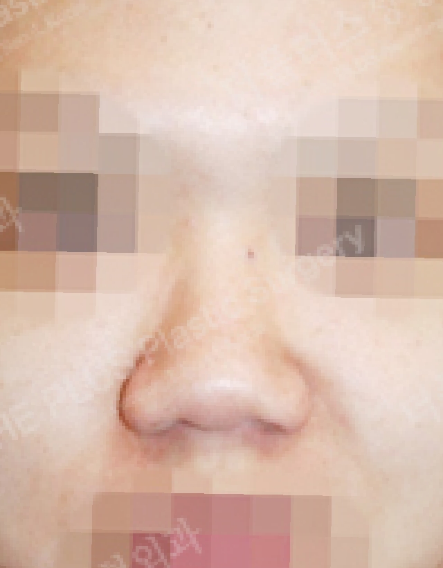 short nose rhinoplasty korea