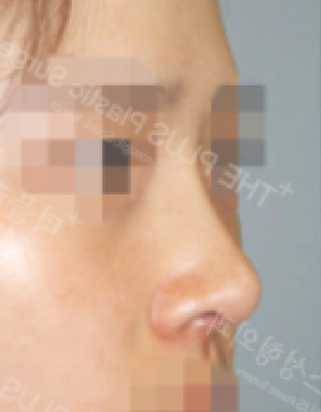 short nose rhinoplasty korea