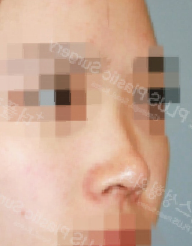 short nose rhinoplasty korea