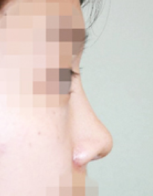 short nose rhinoplasty korea