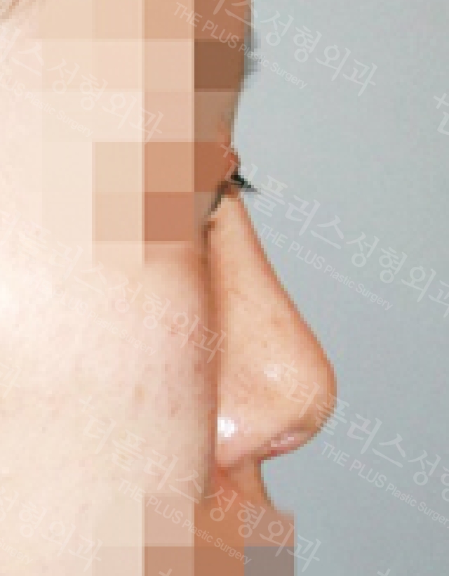 short nose rhinoplasty korea
