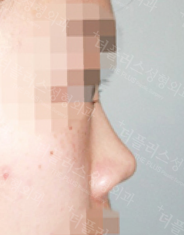 short nose rhinoplasty korea