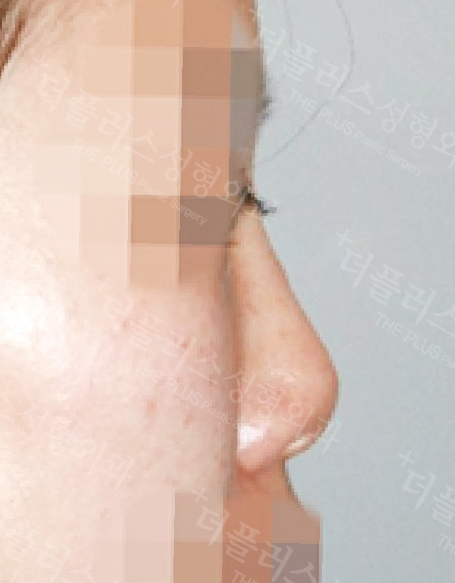 short nose rhinoplasty korea