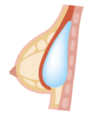 motiva breast implant korea - Motiva Breast Implant